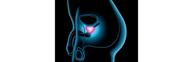Consecinse laradiatile cancerului de prostata
