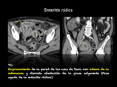 50 sombras de Gy: ¿Qué es la enteritis rádica?